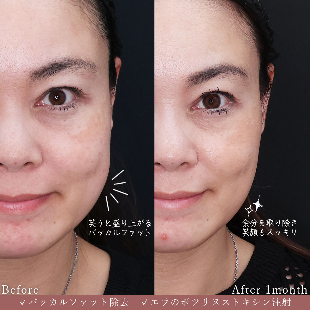 バッカルファット除去/エラボトックス注射の症例写真 施術前後