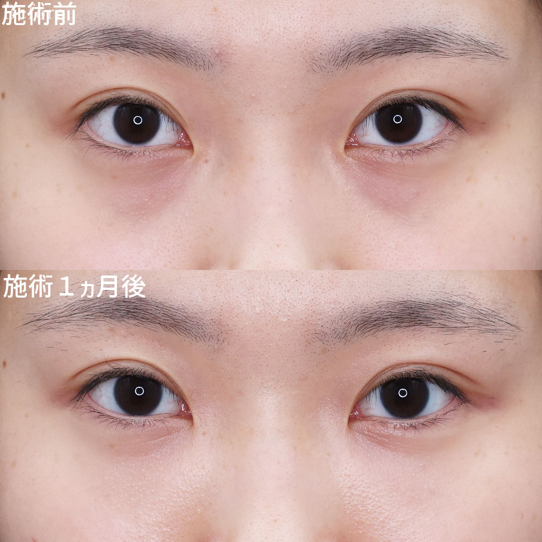 【20代・クマ治療】疲れ顔改善、明るい目元に