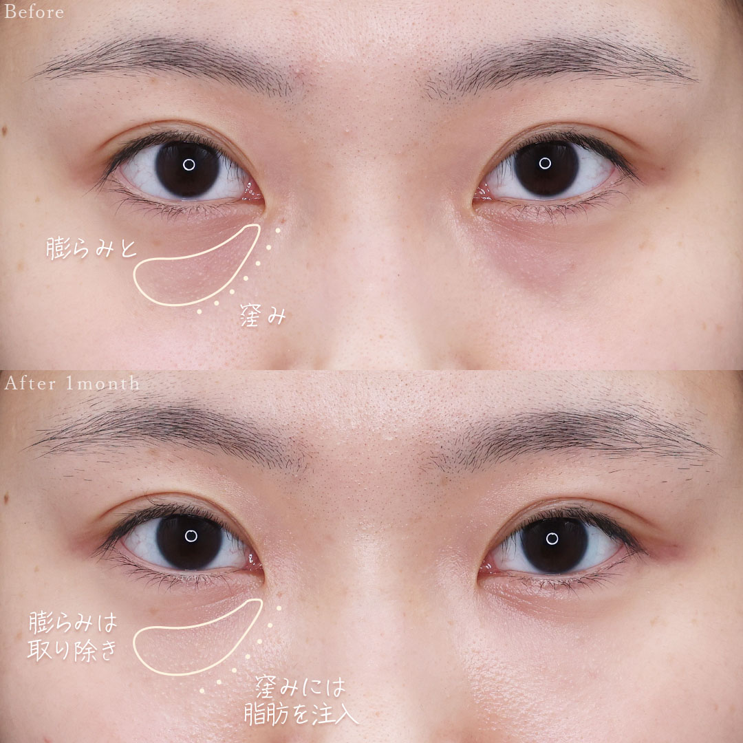 下眼瞼脱脂術（目の下のたるみ取り・目の下の脂肪ふくらみ取り）/顔の脂肪注入(コンデンスリッチフェイス)の症例写真 施術前後 
