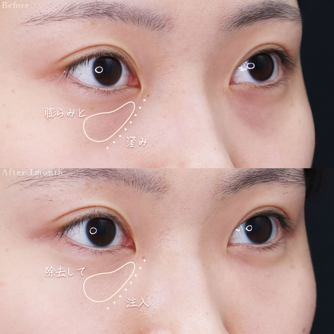 下眼瞼脱脂術（目の下のたるみ取り・目の下の脂肪ふくらみ取り）/顔の脂肪注入(コンデンスリッチフェイス)の症例写真 施術前後 