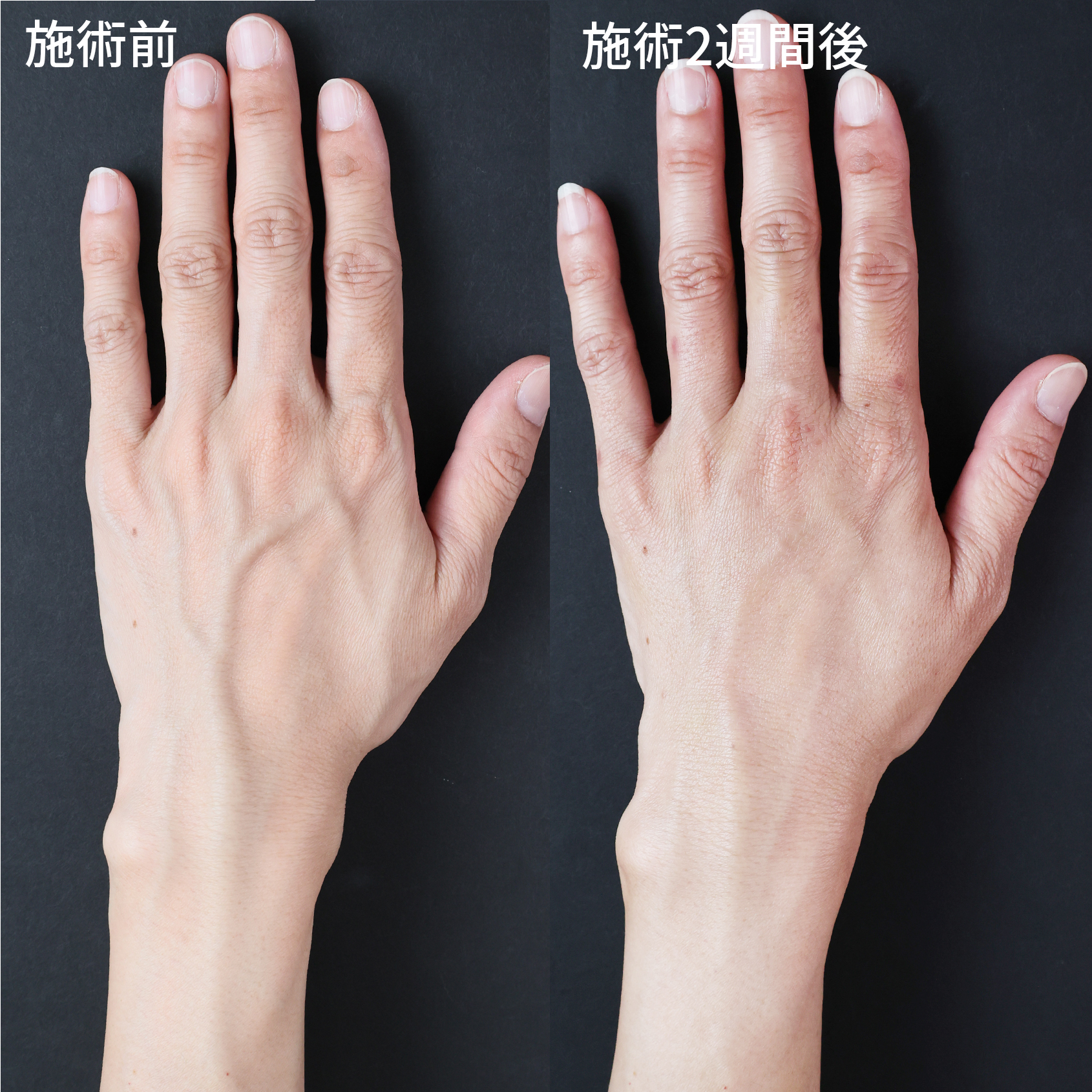 【ハンドベイン治療】で美しい手元に