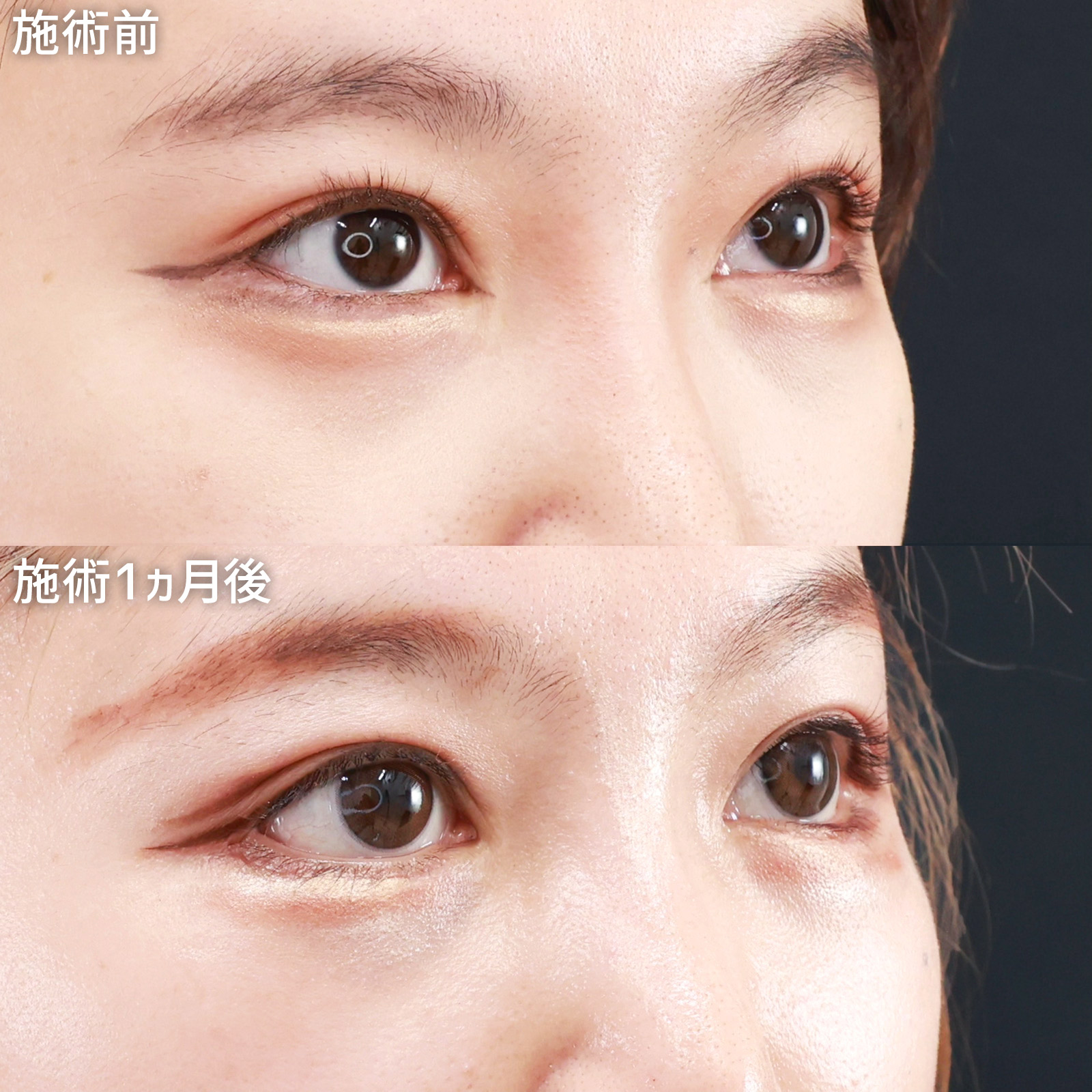 グラマラスライン（タレ目形成）/目尻靭帯移動術/下眼瞼脱脂術（目の下のたるみ取り・目の下の脂肪ふくらみ取り）の症例写真 施術前後 