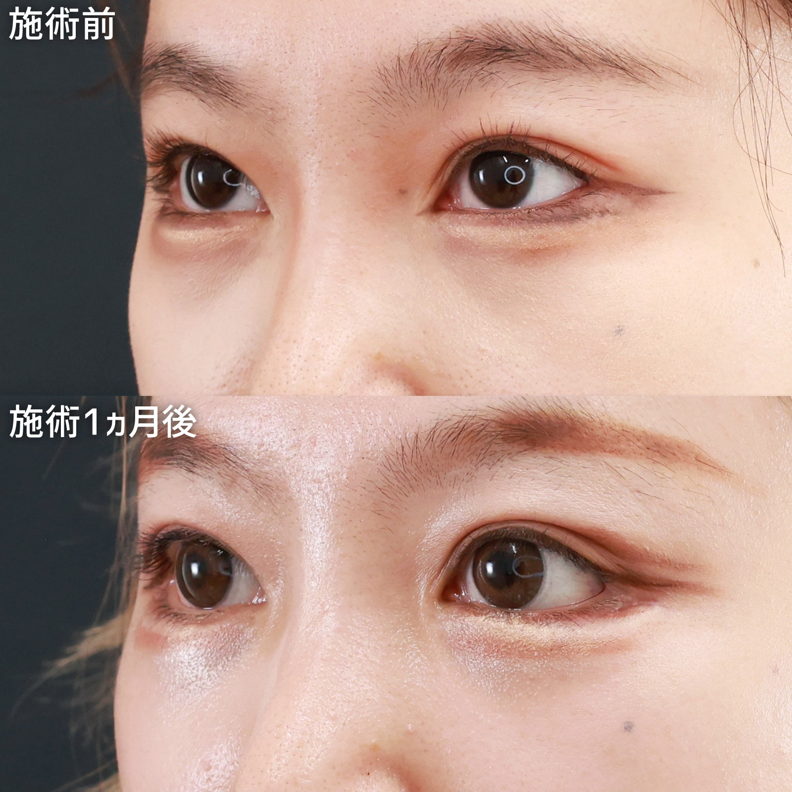 グラマラスライン（タレ目形成）/目尻靭帯移動術/下眼瞼脱脂術（目の下のたるみ取り・目の下の脂肪ふくらみ取り）の症例写真 施術前後 