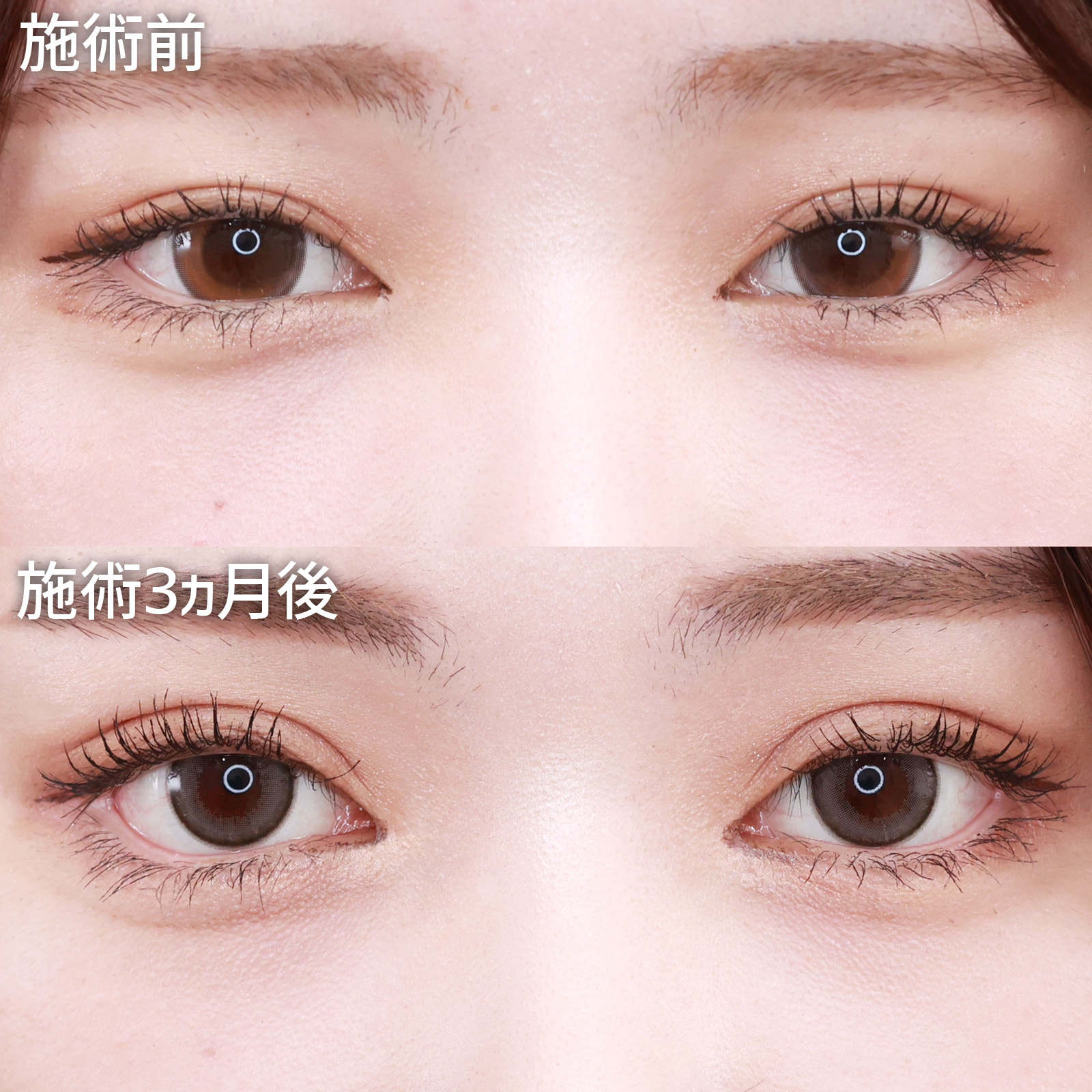 二重切開（全切開法）/グラマラスライン（タレ目形成）/目尻靭帯移動術の症例写真 施術前後 
