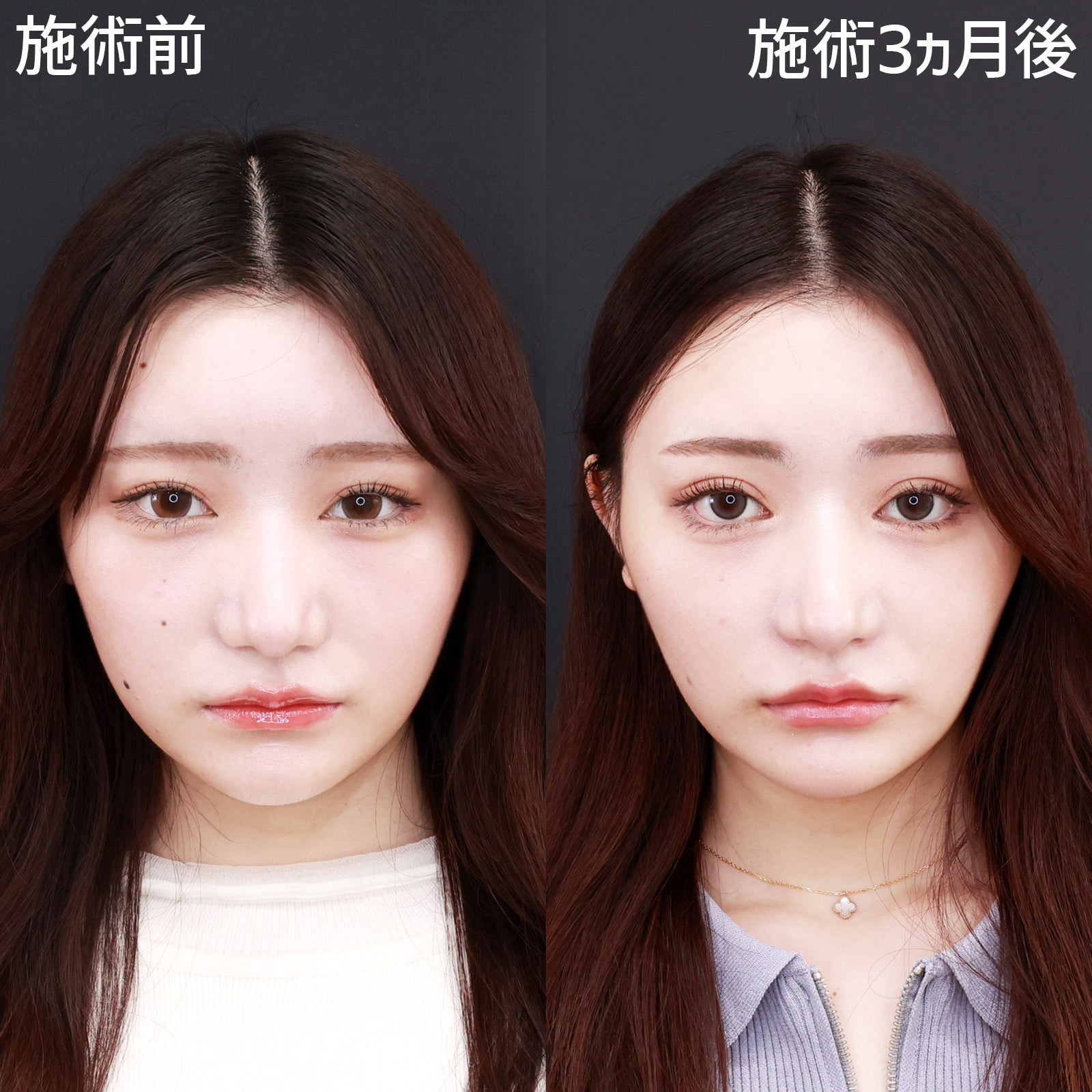 【二重全切開＆グラマラスライン】可愛すぎる幅広平行二重のアーモンドアイを形成！