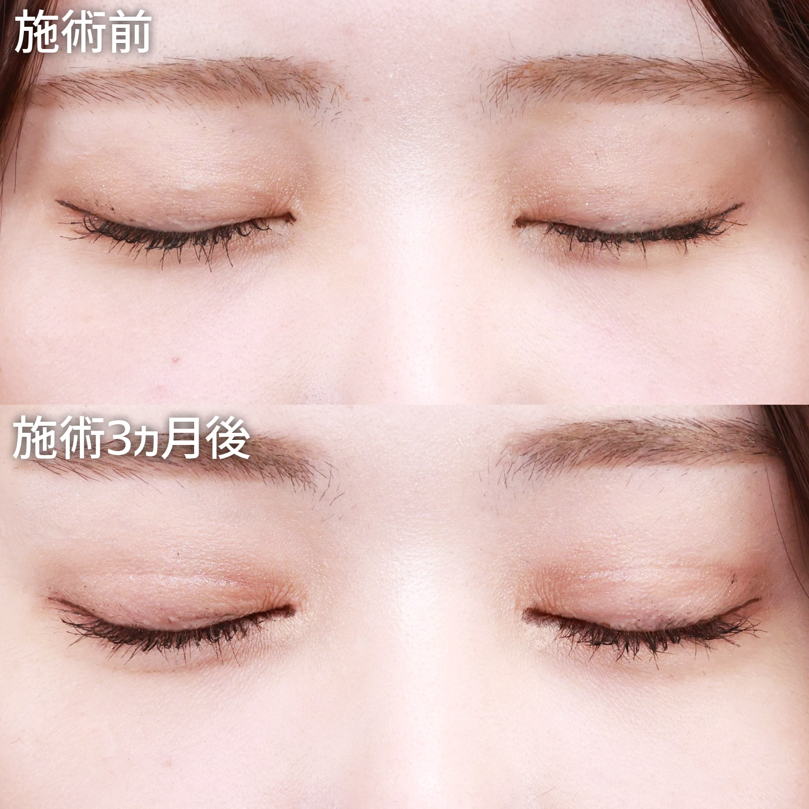 二重切開（全切開法）/グラマラスライン（タレ目形成）/目尻靭帯移動術の症例写真 施術前後 
