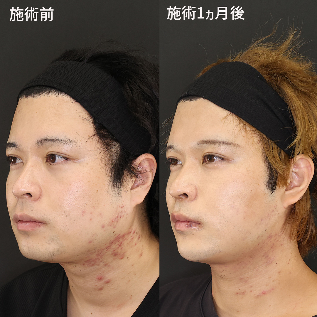 TAC式 ツヤ肌コラーゲンリフト®/ジョールファット除去/Lラインファット除去（エラ下脂肪除去）の症例写真 施術前後 