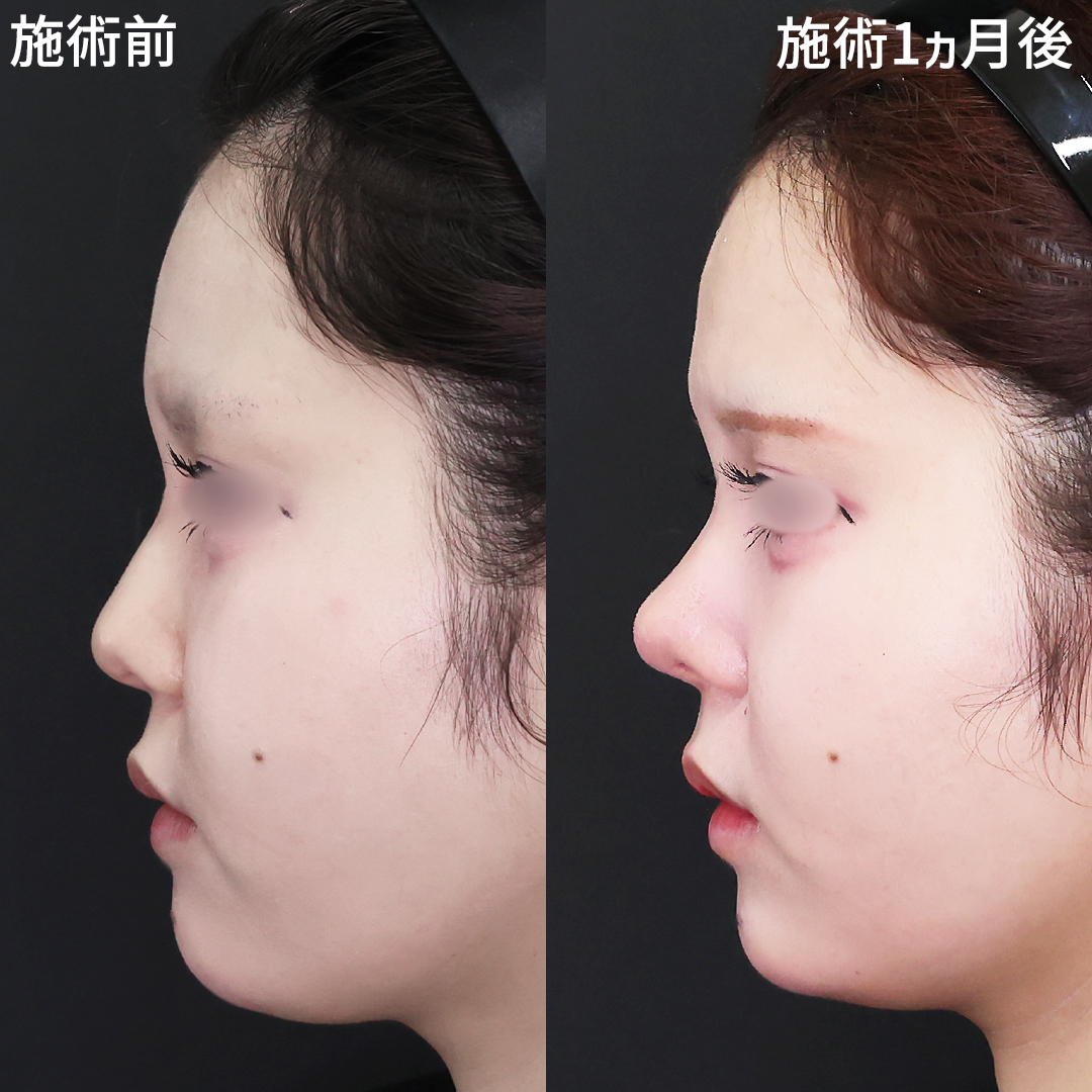 横顔のバランスを整える似合わせ鼻整形