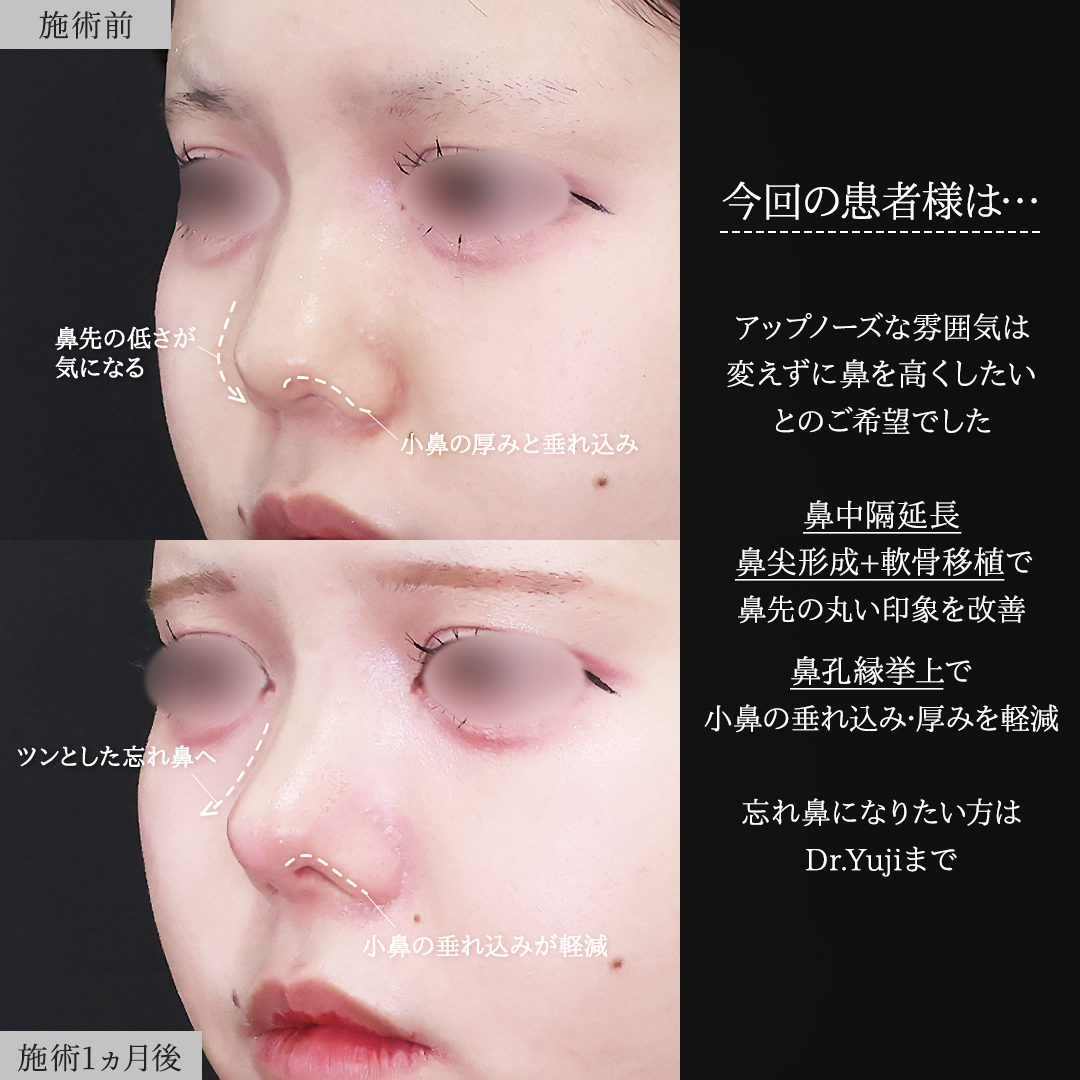 鼻尖形成・鼻尖縮小/鼻中隔延長術/鼻孔縁挙上術の症例写真 施術前後 