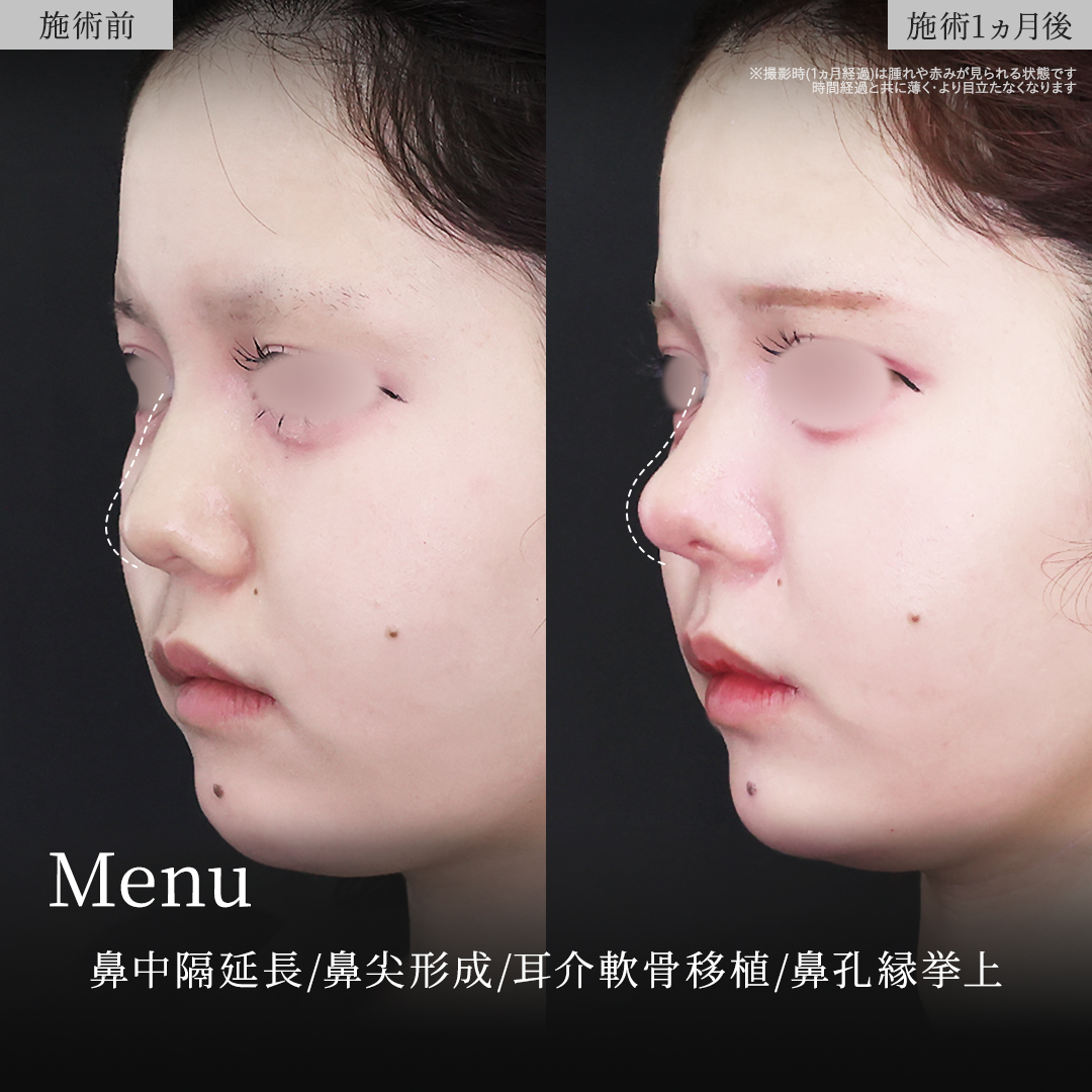 鼻尖形成・鼻尖縮小/鼻中隔延長術/鼻孔縁挙上術の症例写真 施術前後 
