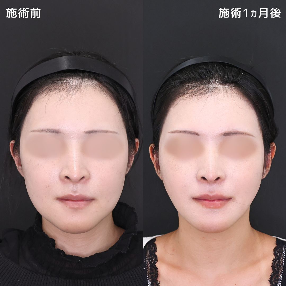 小顔 手術の症例写真・画像・ビフォーアフター｜美容整形・美容