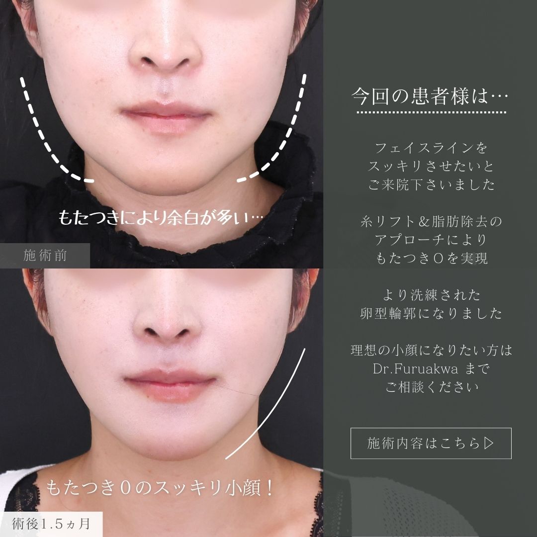 TAC式 ツヤ肌コラーゲンリフト®/ジョールファット除去/エラボトックス注射の症例写真 施術前後 