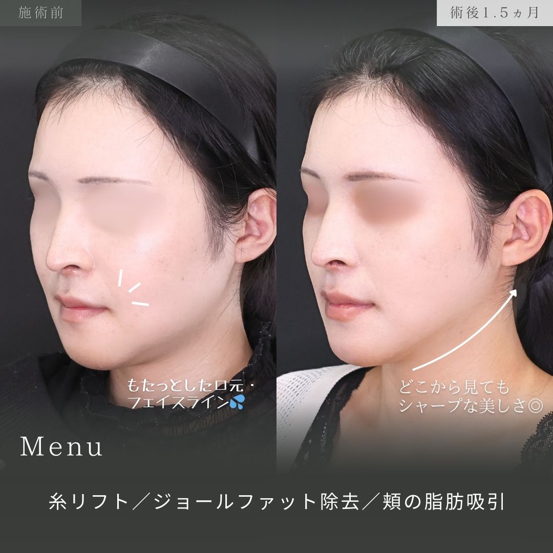 TAC式 ツヤ肌コラーゲンリフト®/ジョールファット除去/エラボトックス注射の症例写真 施術前後 