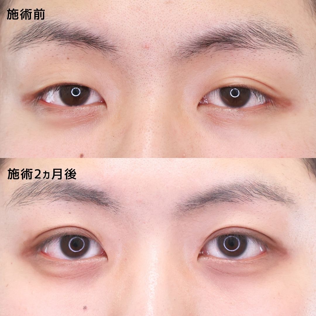二重埋没法の症例写真 施術前後