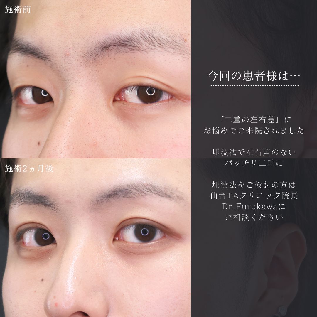 二重埋没法の症例写真 施術前後