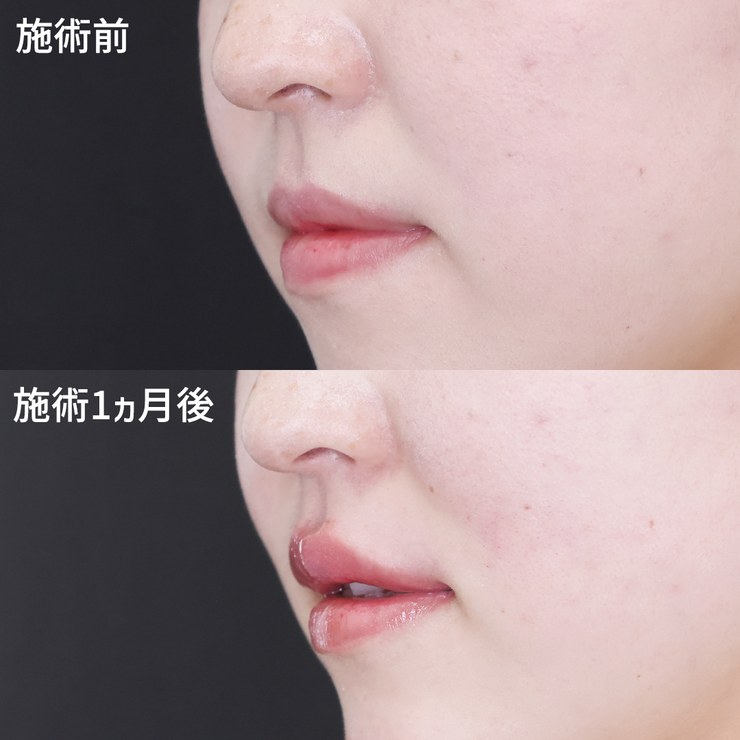 注射・プチ整形:その他/ヒアルロン酸注射:その他の症例写真 施術前後