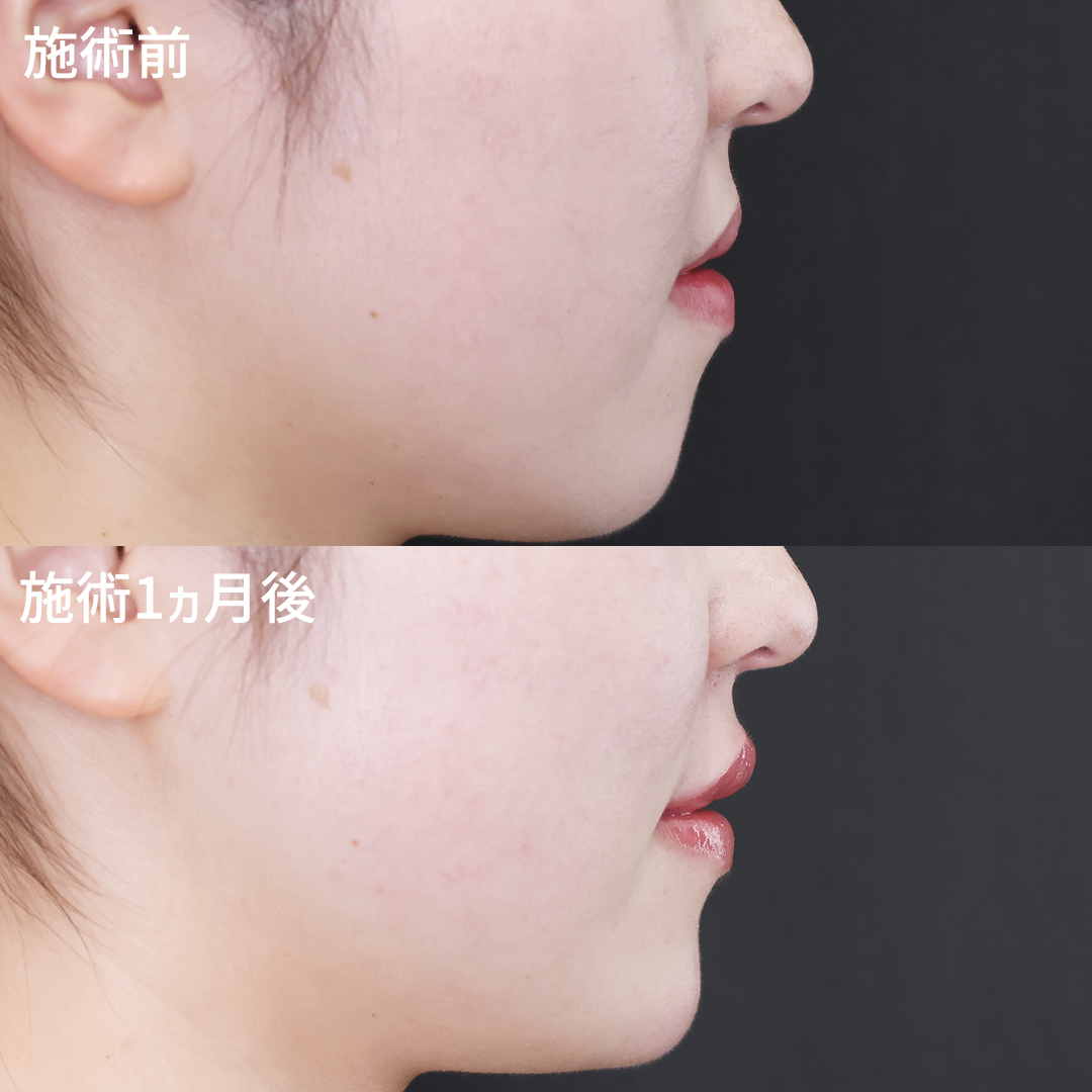 注射・プチ整形:その他/ヒアルロン酸注射:その他の症例写真 施術前後