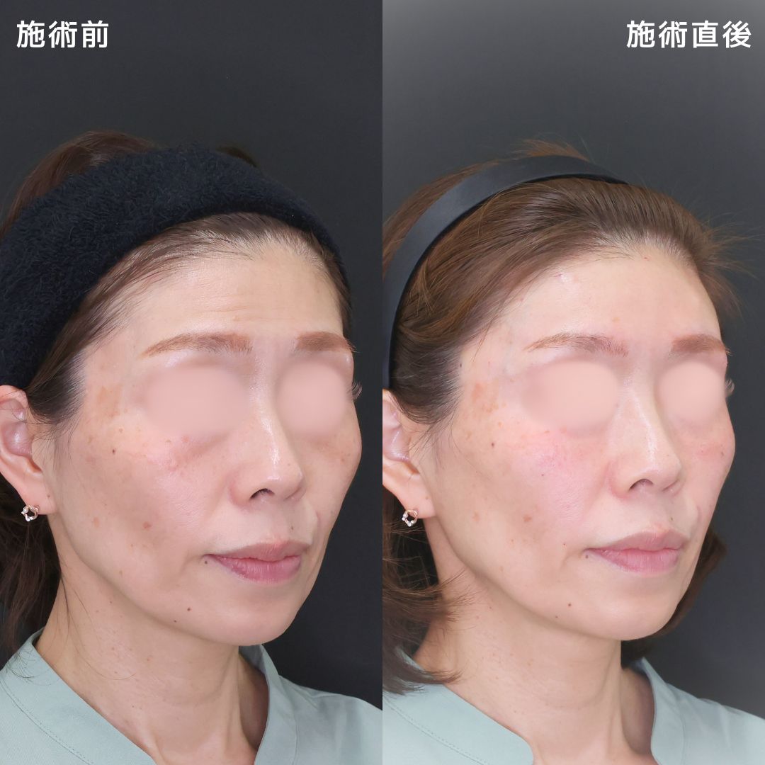 ヒアルロン酸注射:その他/ボトックス注射:その他の症例写真 施術前後