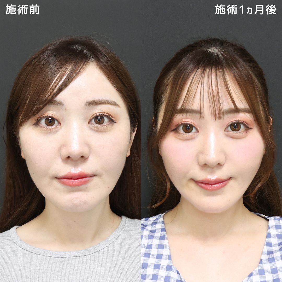 《脂肪吸引》×《脂肪除去》でより美しい小顔に！