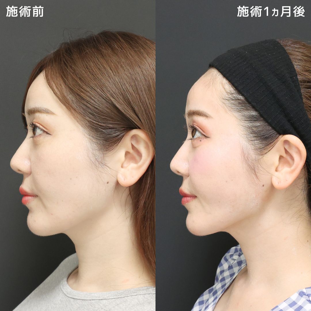 TAC式 ツヤ肌コラーゲンリフト®/ジョールファット除去/Lラインファット除去（エラ下脂肪除去）の症例写真 施術前後 