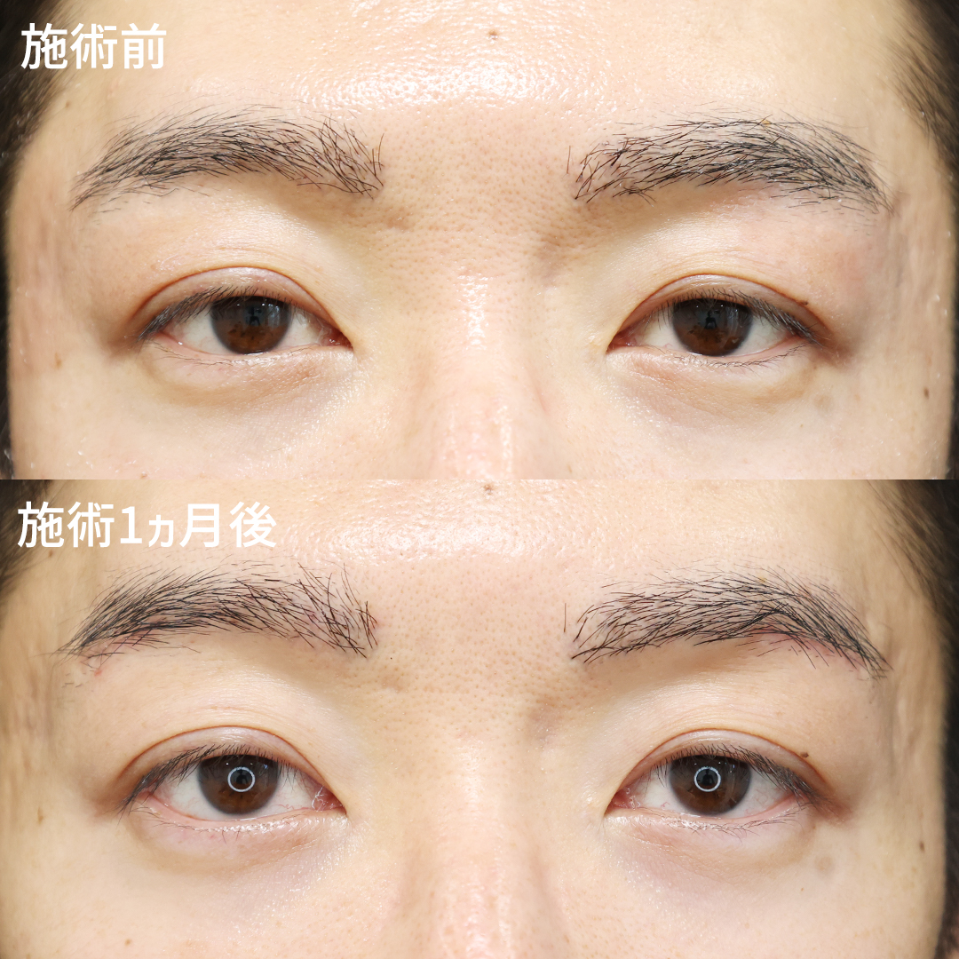 眉毛下切開術でスッキリとした目もとへ