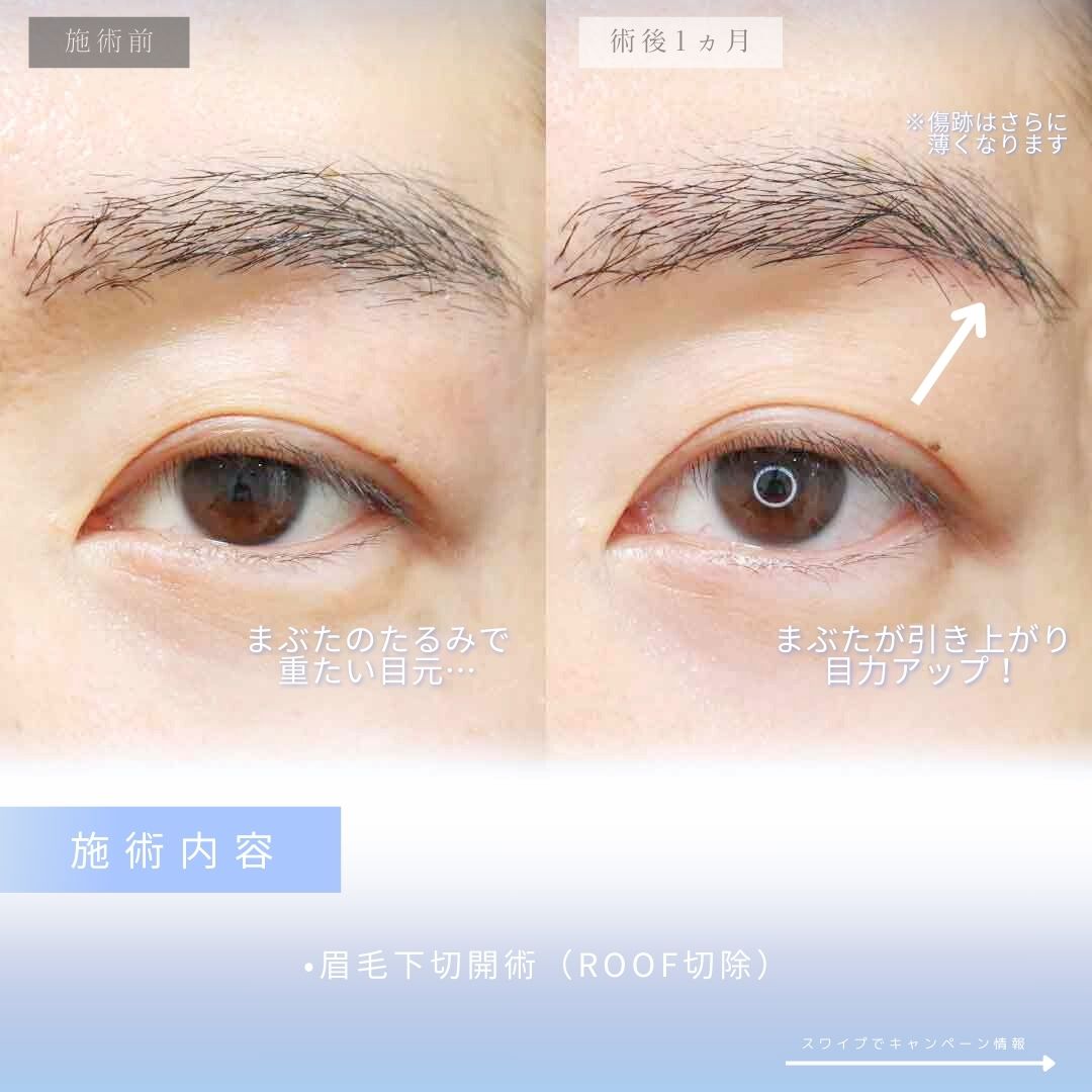 眉毛下切開術の症例写真 施術前後 