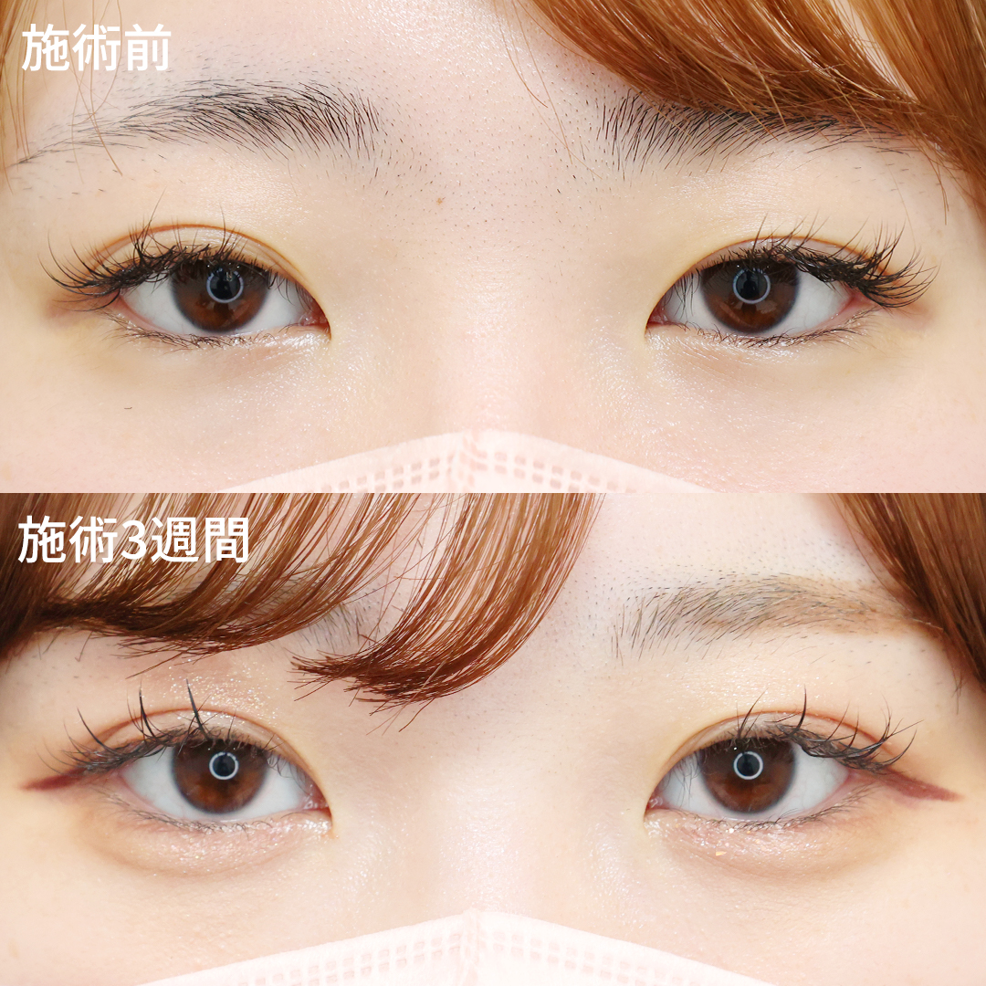 左右差のないMIX二重でメイク映え！