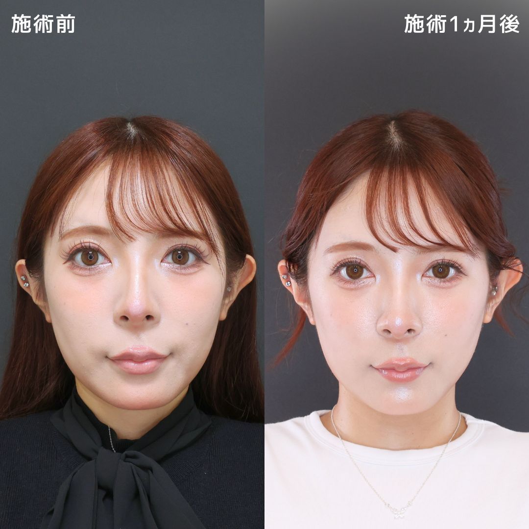 糸リフトで気になる『頬コケ』を改善！