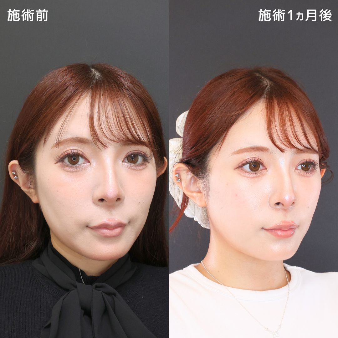 TAC式 ツヤ肌コラーゲンリフト®/エラボトックス注射の症例写真 施術前後 