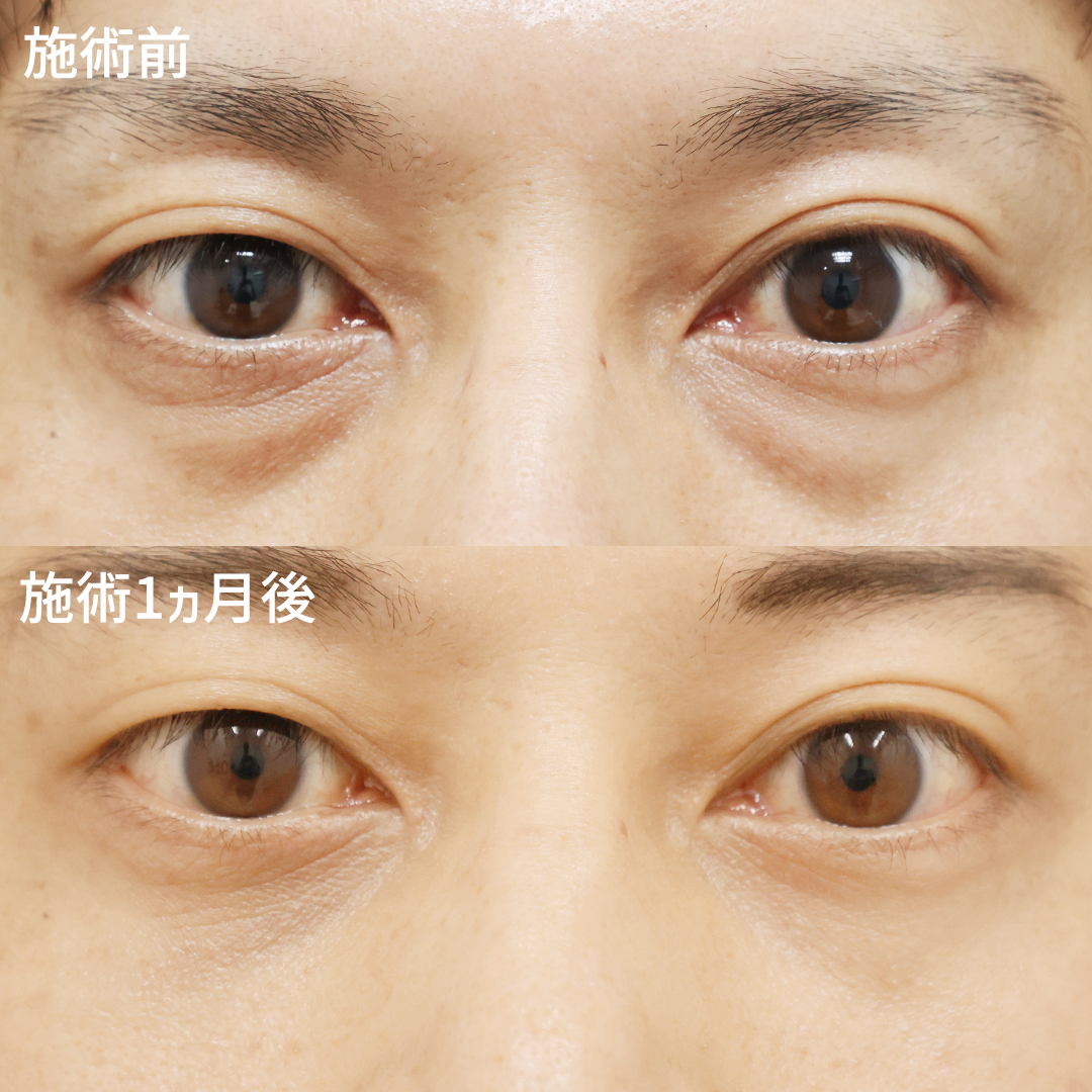 【メンズ整形】黒クマ撃退で驚くほどに若返り！