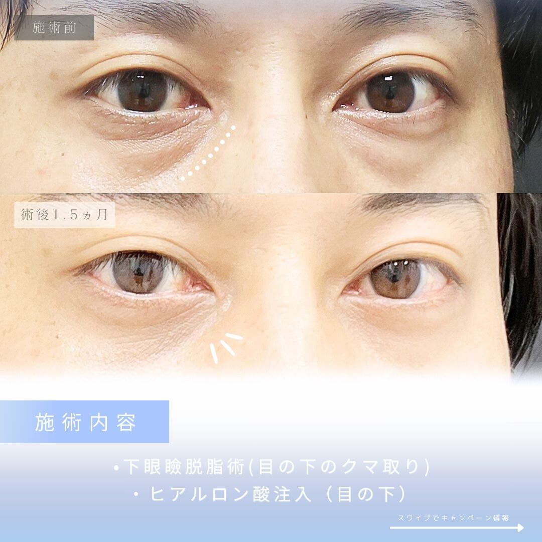 下眼瞼脱脂術（目の下のたるみ取り・目の下の脂肪ふくらみ取り）/目の下のヒアルロン酸注射の症例写真 施術前後 