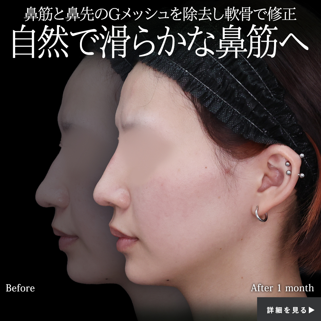 隆鼻術（プロテーゼ・自家組織）/鼻尖形成・鼻尖縮小/鼻先軟骨移植の症例写真 施術前後 