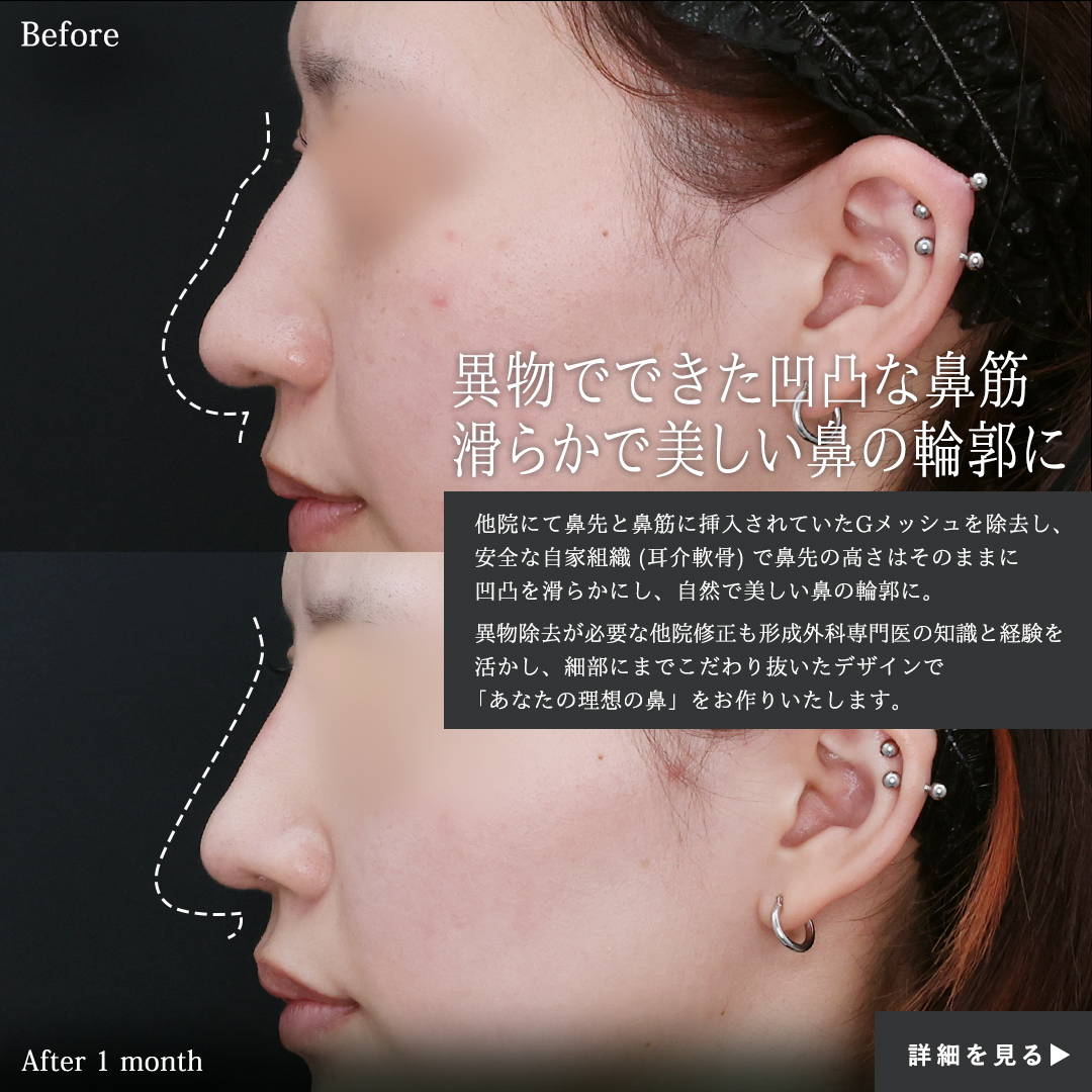 隆鼻術（プロテーゼ・自家組織）/鼻尖形成・鼻尖縮小/鼻先軟骨移植の症例写真 施術前後 