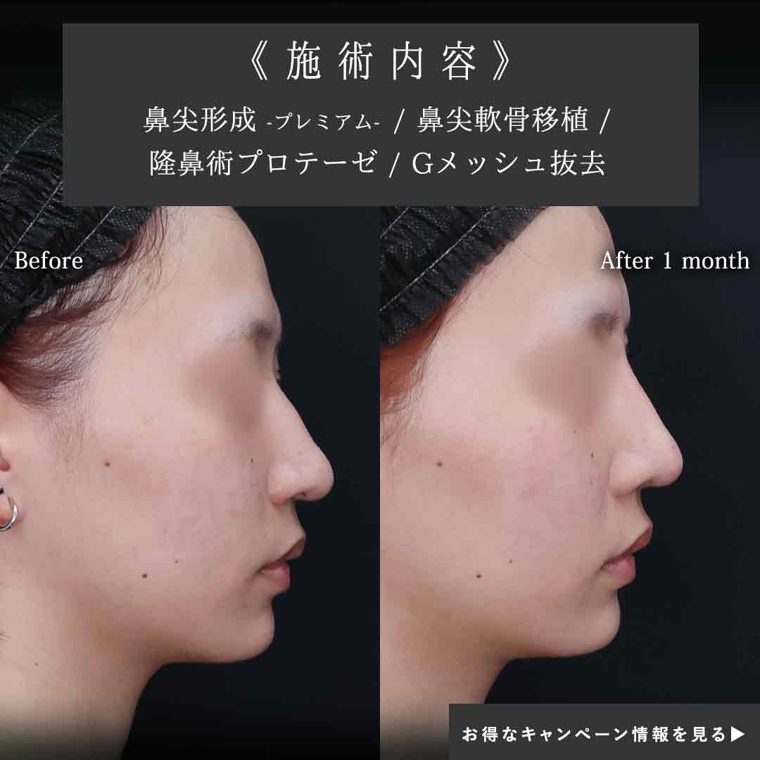 隆鼻術（プロテーゼ・自家組織）/鼻尖形成・鼻尖縮小/鼻先軟骨移植の症例写真 施術前後 