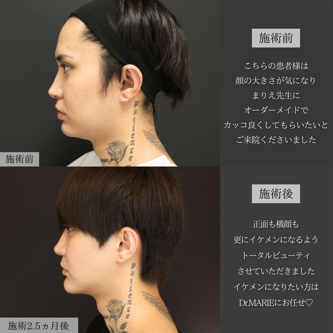 バッカルファット除去/エラボトックス注射/ジョールファット除去の症例写真 施術前後 