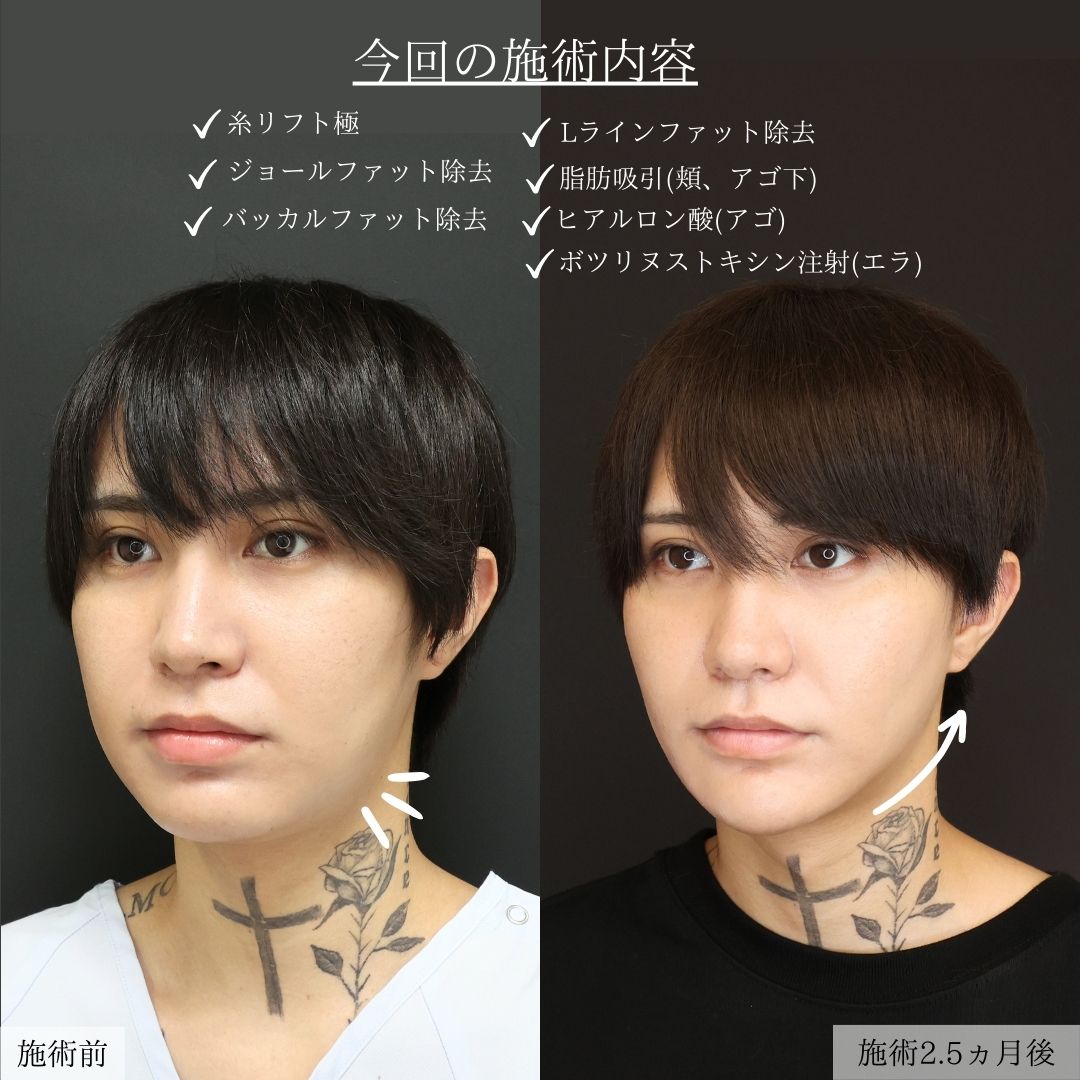 バッカルファット除去/エラボトックス注射/ジョールファット除去の症例写真 施術前後 