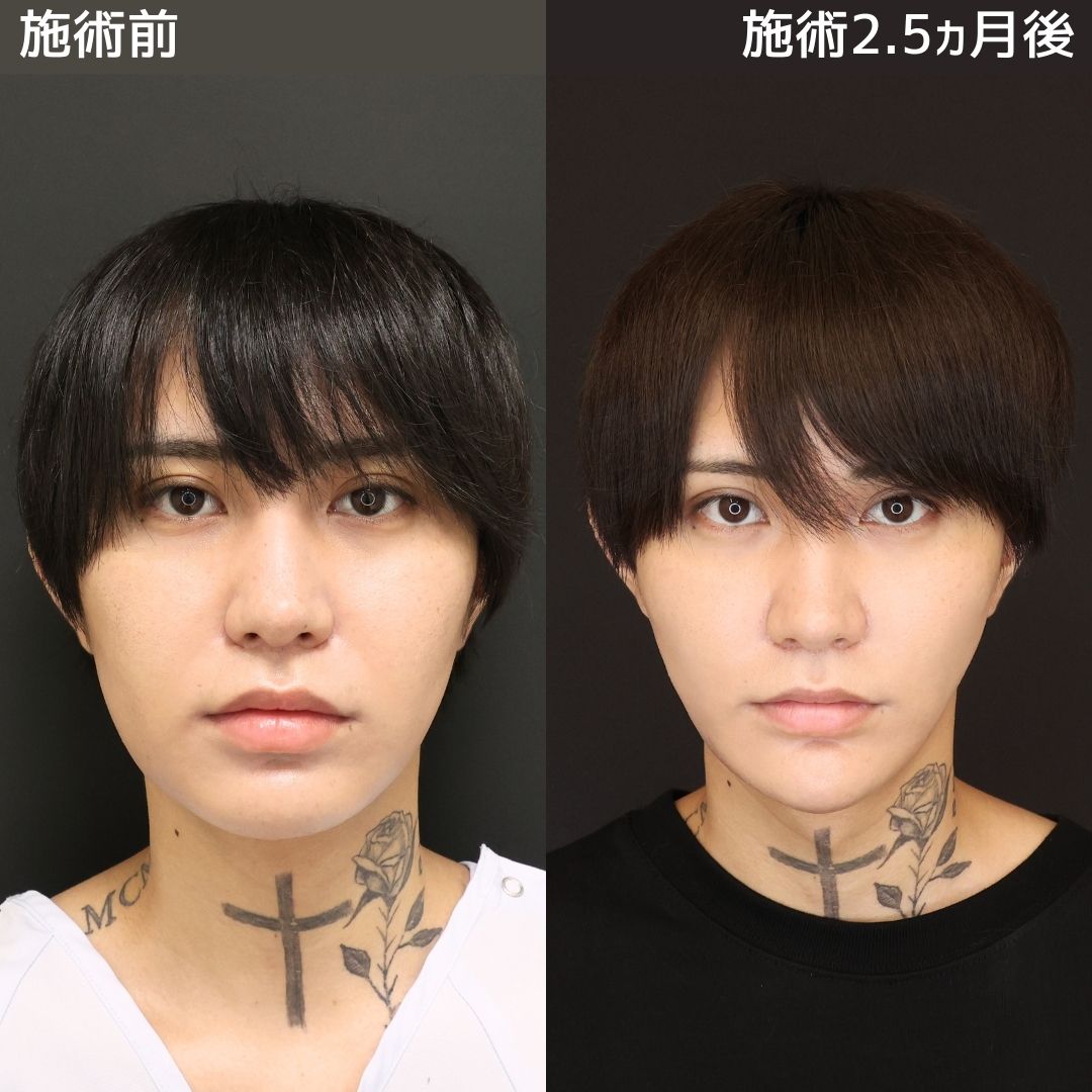 《オーダーメイド小顔術》さらにイケメン度アップ?