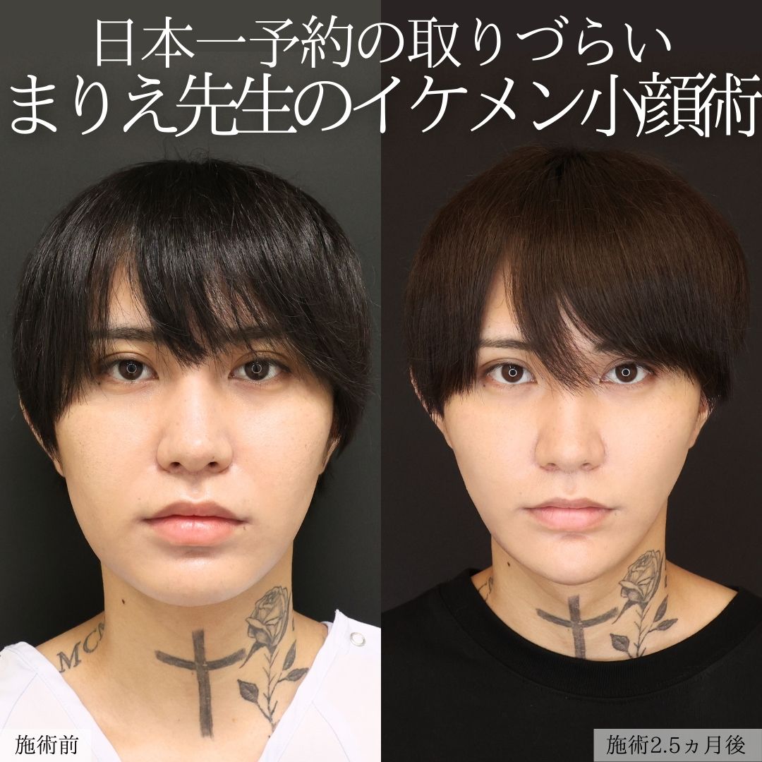 バッカルファット除去/エラボトックス注射/ジョールファット除去の症例写真 施術前後 