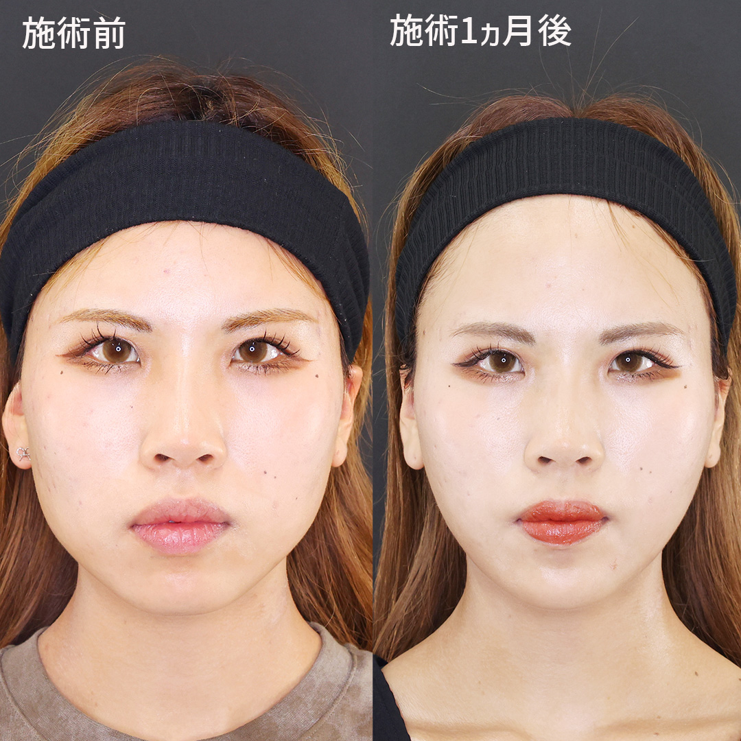 お悩み箇所を糸リフトで解決！即日叶う小顔術✨