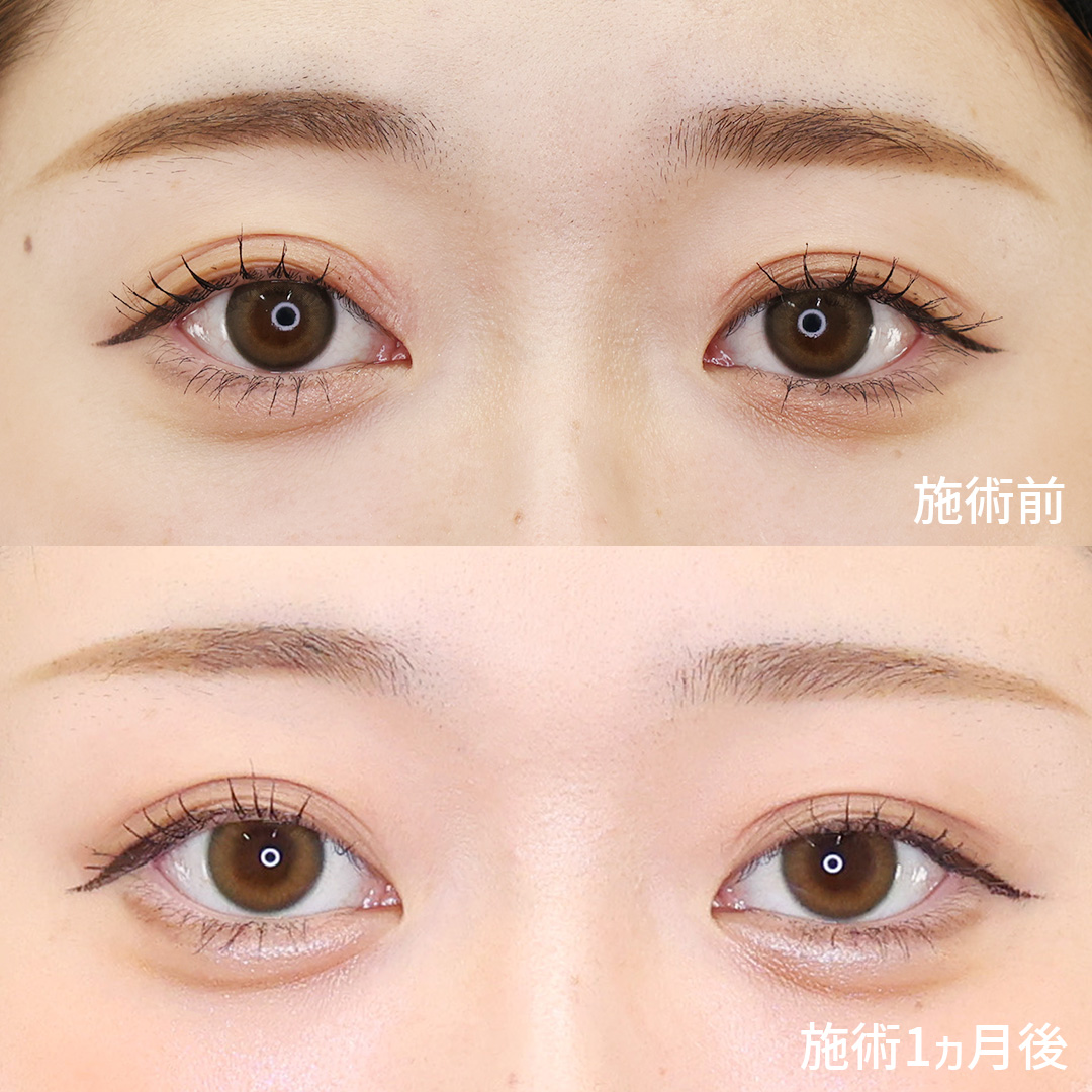 【涙袋のヒアルロン酸注入】すっぴんから可愛いが作れる?