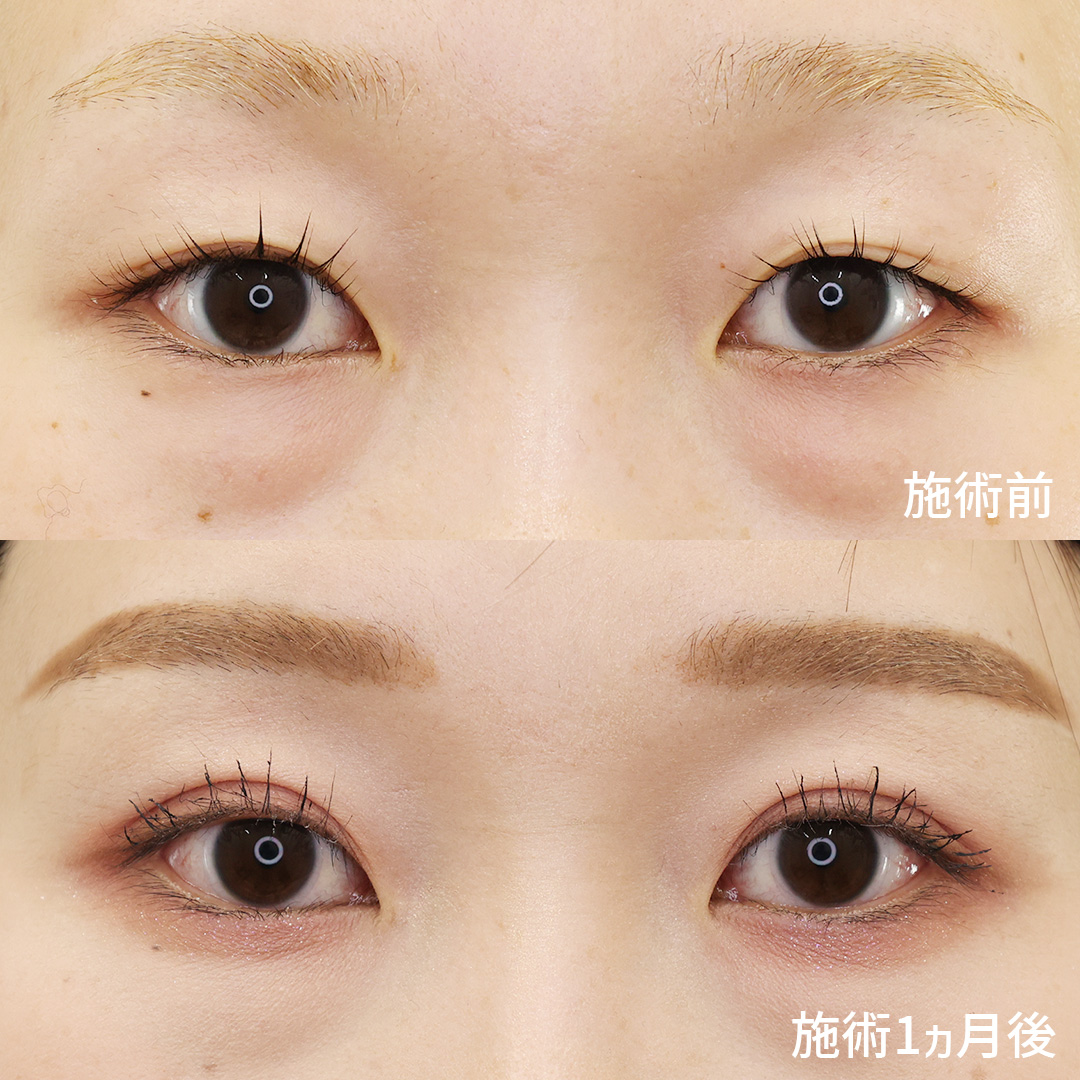 【二重埋没法】長年のアイプチ生活卒業?✨