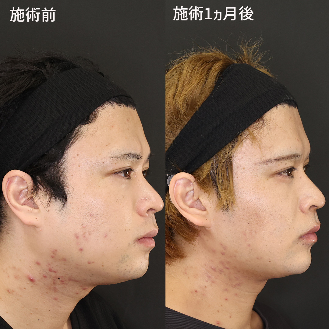 TAC式 ツヤ肌コラーゲンリフト®/ジョールファット除去/Lラインファット除去（エラ下脂肪除去）の症例写真 施術前後 