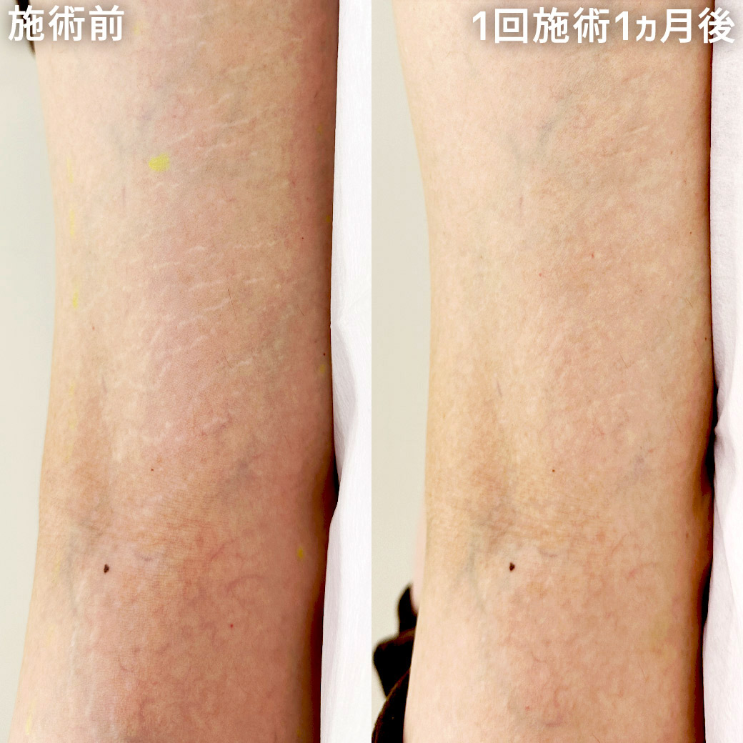 アートメイクSkin52（妊娠線・肉割れ・ストレッチマーク・リスカ跡・傷跡修正）の症例写真 施術前後 