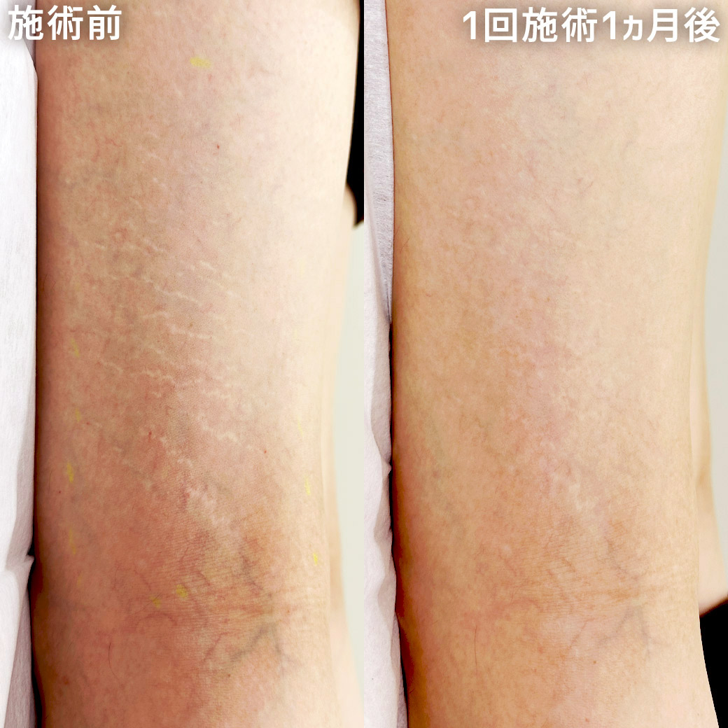 【Skin52】体重の増減でできた太ももの肉割れを、傷跡修正アートメイクで目立ちにくく