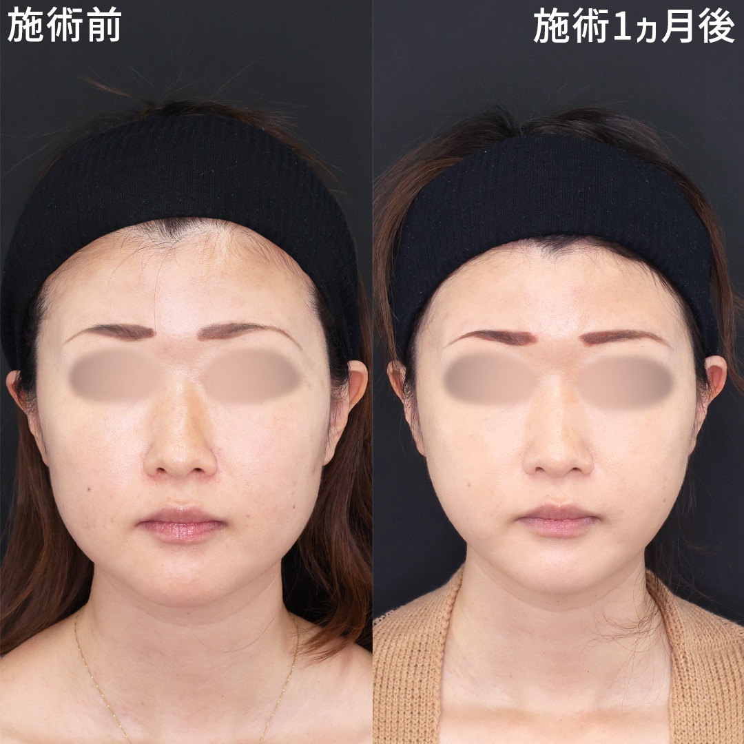 【下膨れ改善】お顔の余白を少なく