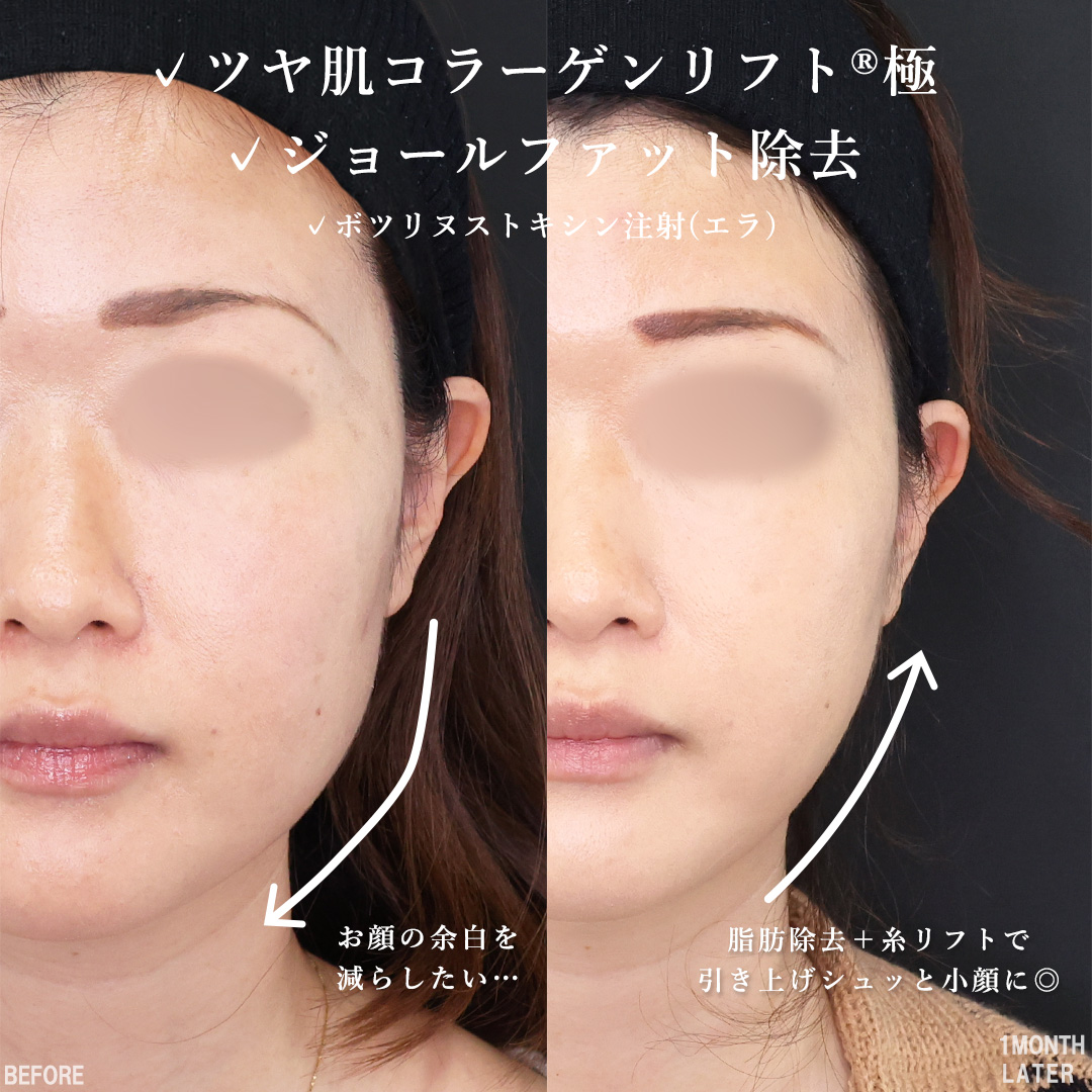 TAC式 ツヤ肌コラーゲンリフト®/ジョールファット除去/エラボトックス注射の症例写真 施術前後 