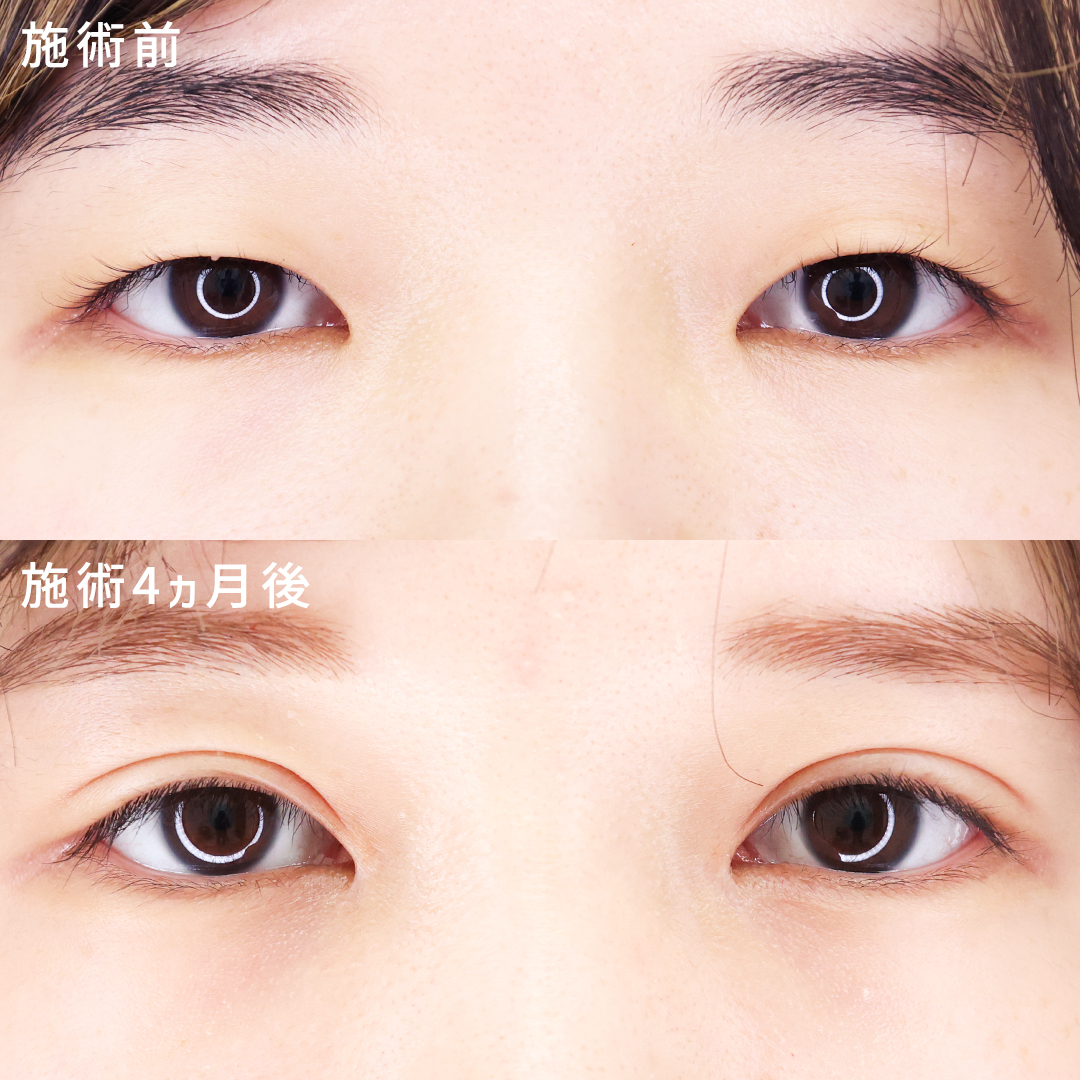 目頭切開＆埋没で叶える｜ぱっちり華やかな目元術