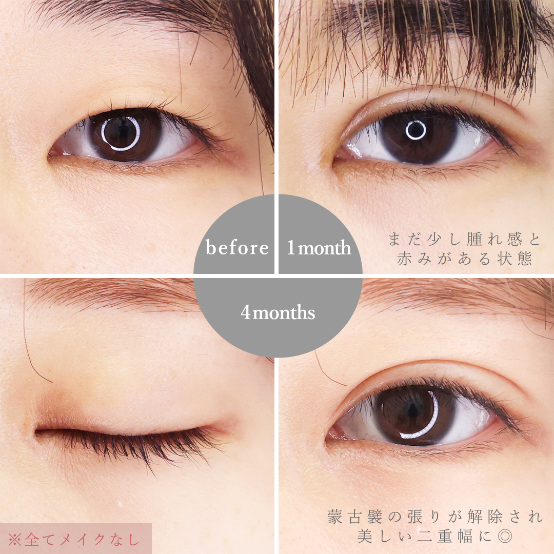 目頭切開術/二重埋没法/鼻のヒアルロン酸注射の症例写真 施術前後 