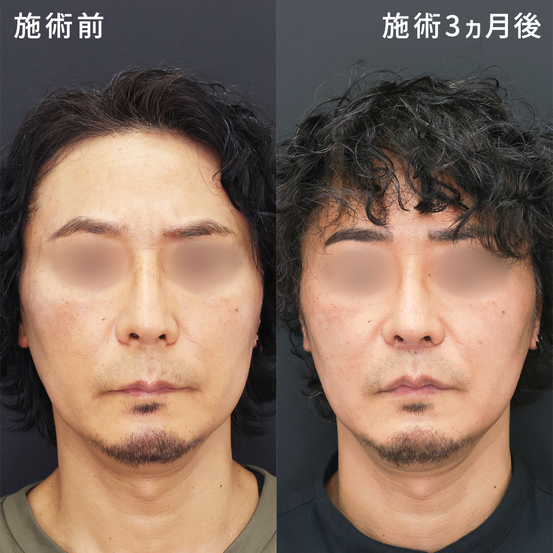 50代男性｜人中を短くしよりイケオジに