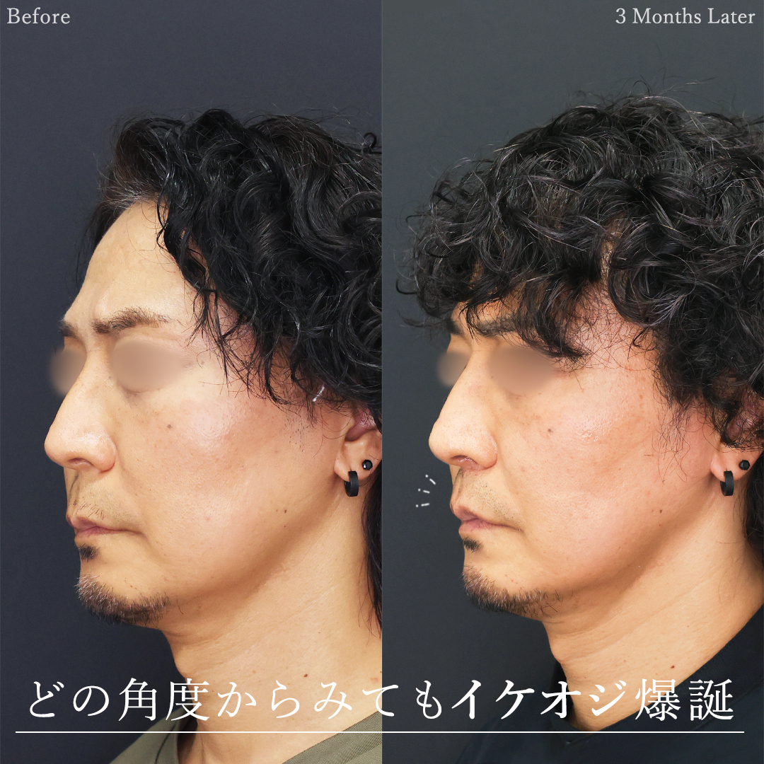 人中短縮術(リップリフト)・外側人中短縮術の症例写真 施術前後 